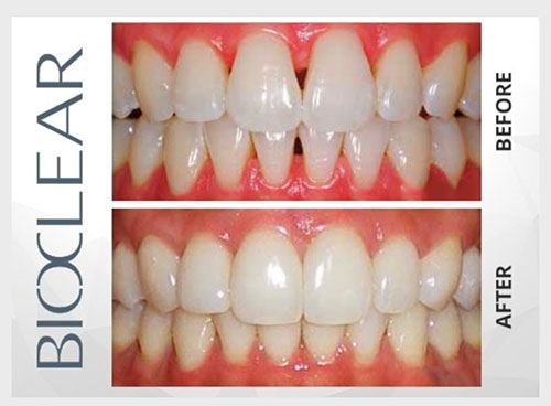 Before and After image of Bioclear Treatment