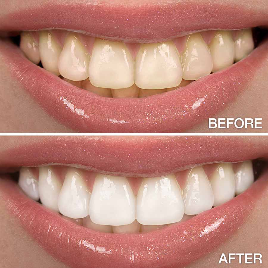 before and after teeth whitening photo