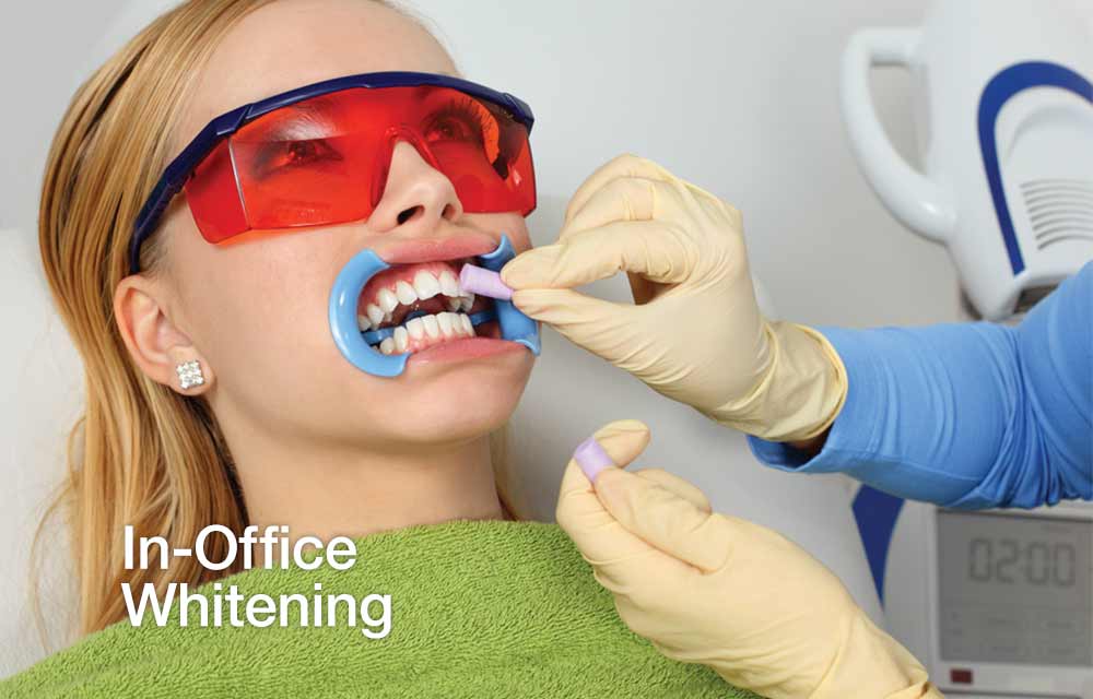 dentist wearing gloves whitening a patient's teeth in-office