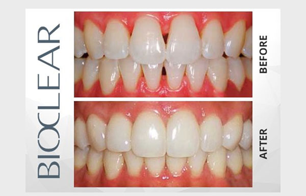 Bioclear before and after photo